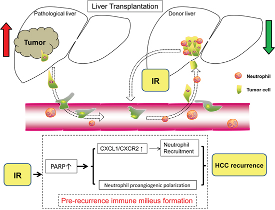 Schematic diagram for the mechanisms of PARP-1 in the promotion of HCC recurrence after liver transplantation through IR-mediated neutrophils recruitment and polarization.