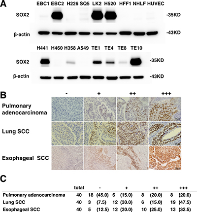 SOX2 expression in lung, esophageal SCC and pulmonary adenocarcinoma.