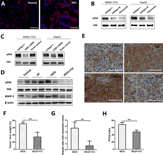 The expression of phospho-FAK in NAFLD-related HCC.