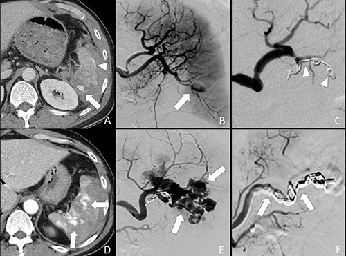 52-year-old male of grade IV splenic injury underwent combined embolization because of distal embolization failure.