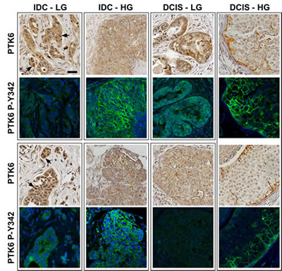Active P-Y342 PTK6 is localized at the plasma membrane in high-grade ductal carcinomas.