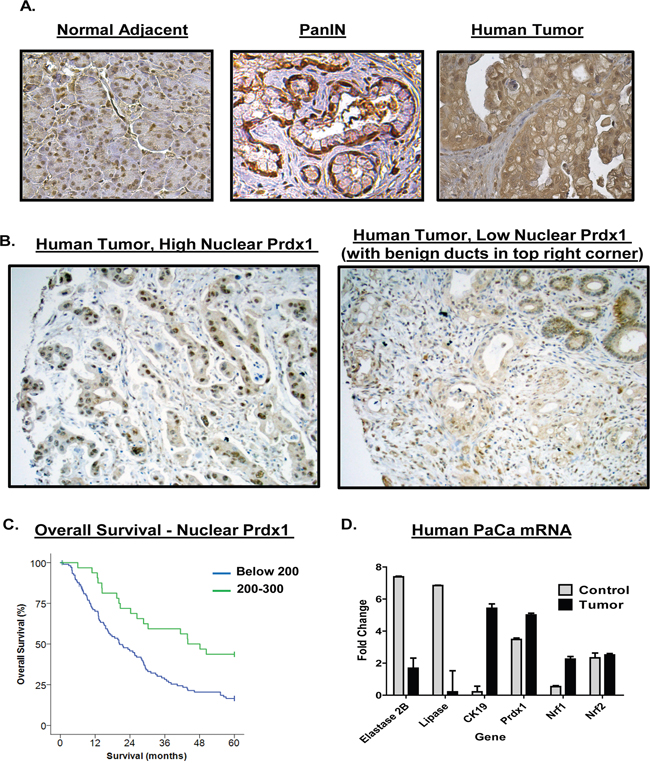 Upregulation of Prdx1 expression in human pancreatic cancer patients.