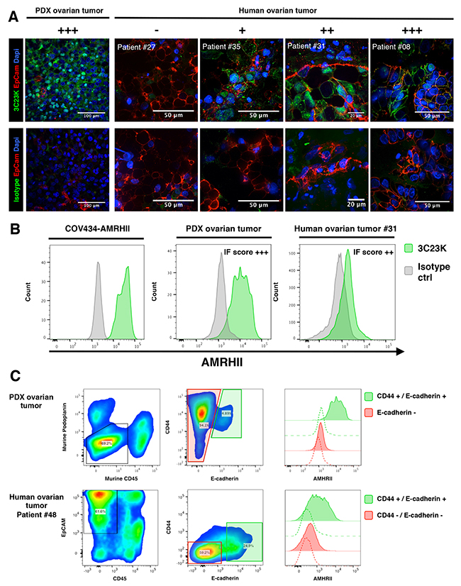 Immunofluorecence determination of AMHRII expression: AMHRII is heterogeneously expressed in human ovarian cancers and stained by the glycoengineered anti-human AMHRII humanized mAb 3C23K.