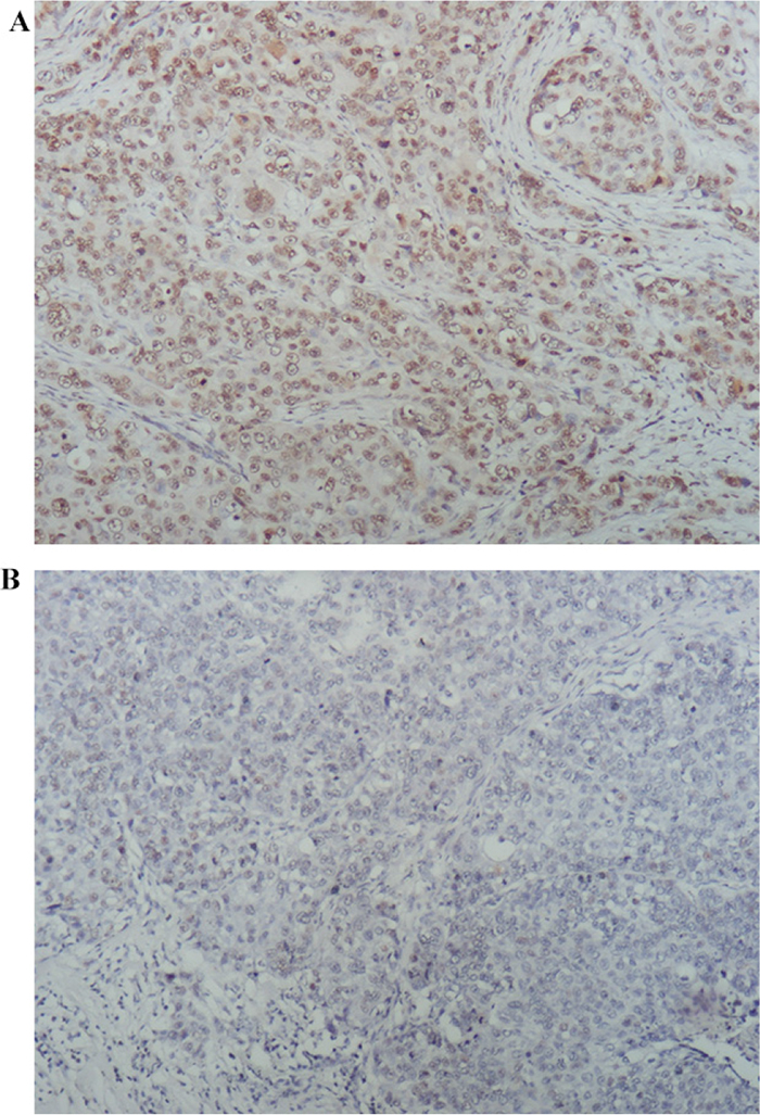 PARP1 expression by IHC staining.
