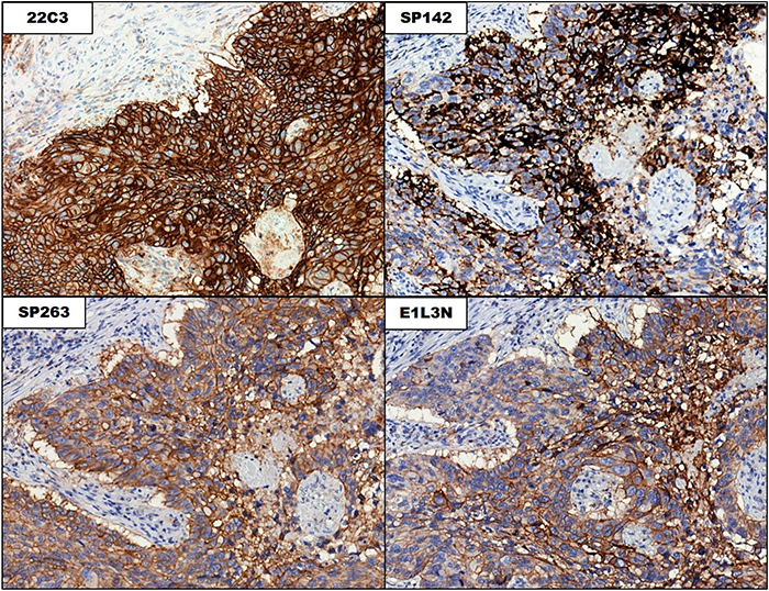 Staining patterns in the tumor cells in the 4 PD-L1 immunohistochemical assays.