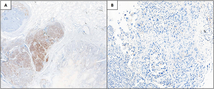 Representative images of discordant non-small cell lung cancer cases between the whole-tissue section (A, 10&#x00D7; magnification) and matched tissue microarray specimen (B, 20&#x00D7; magnification).