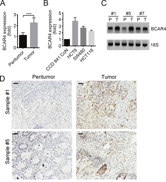 BCAR4 is highly expressed in colon cancer.