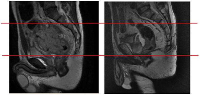 Representative images of two patients with pelvic recurrence.