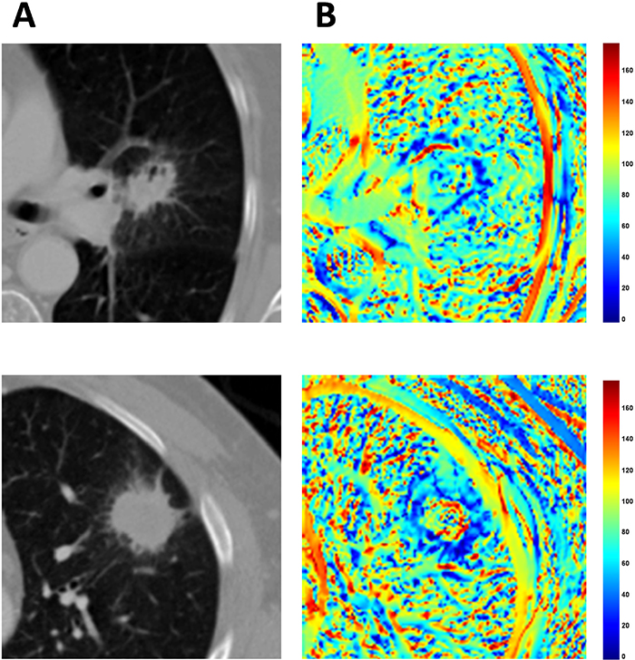 Volume of interests (VOI) for two lung cancer patients with extreme differences in clinical outcomes.