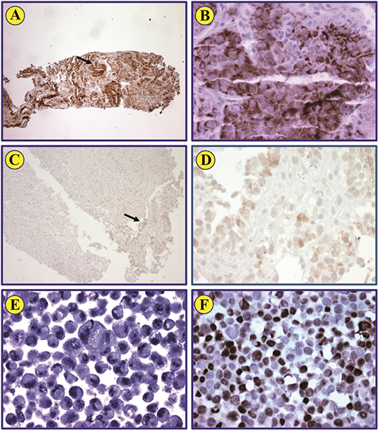 HIF-1&#x03B1; expression in pre- and post-treatment biopsies from renal cell carcinoma patient.