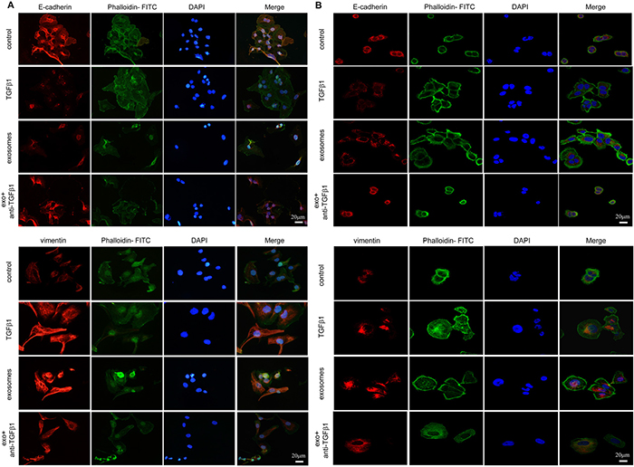 EMT transition of cells cultured with PBS, TGF&#x03B2;1, CAF-derived exosomes and exosomes with neutralizing TGF&#x03B2;1 antibody in immunofluorescence.