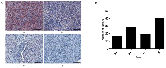 THBS1 immunostaining in melanoma tumor tissue.