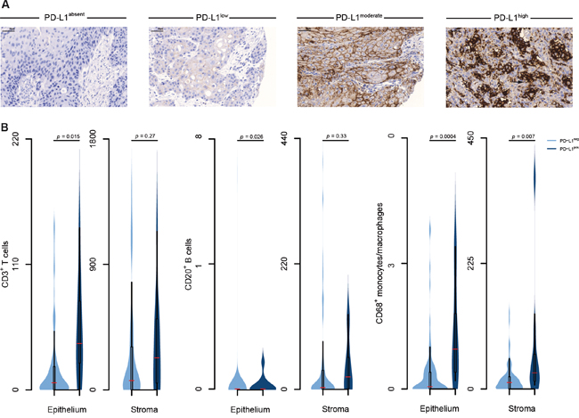 Identification of an immune microenvironment in VSCC.