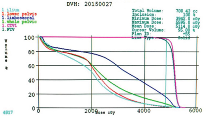 DVH of IMRT plan.