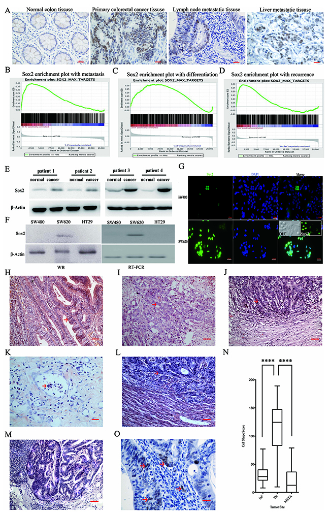 Sox2 expression in clinical tumor tissues and cell lines.