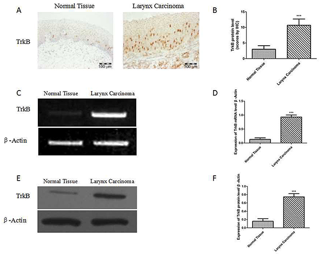 Elevated TrkB expression in laryngeal cancer tissues and laryngeal cancer cells.