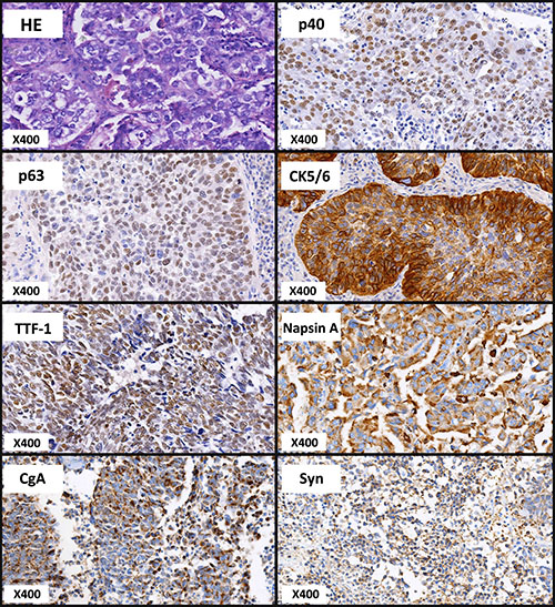 Representative images of HE and IHC staining for LCCs.