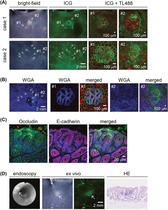 ICG fluorescence imaging of macroscopically small proliferative lesions in AOM-induced colon carcinogenesis in rats after a 30-min ICG enema.