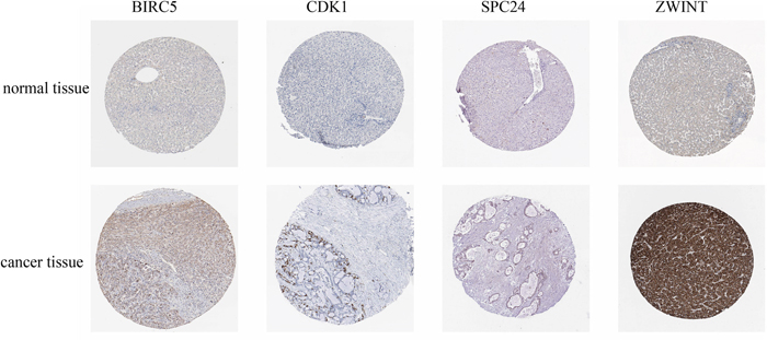 Immunohistochemistry of core genes in normal and cancerous tissue.