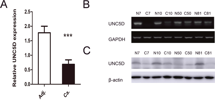 UNC5D is attenuated or silenced in PTC tissues.