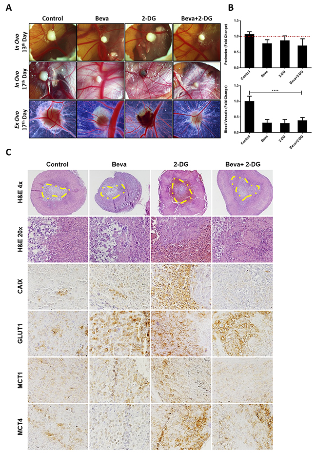 In vivo effect of Bevacizumab in combination with glucose analogue 2-DG in U251 induced tumors.