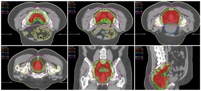 The isodose distributions for one representative patient planned by volumetric modulated arc therapy are shown with axial (upper panel and lower-left), coronal (lower-middle) and sagittal (lower-right) views.
