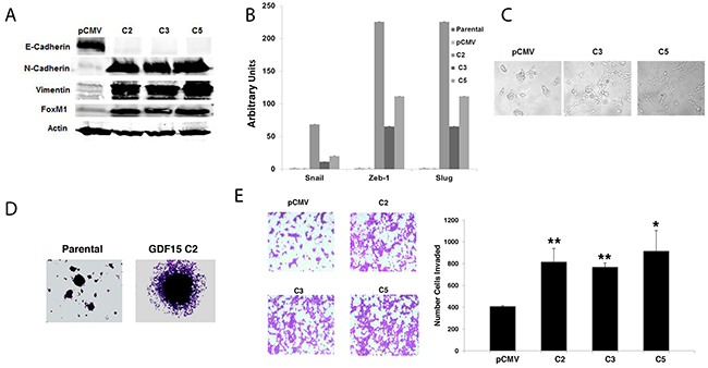 GDF15 induces epithelial mesenchymal transition and invasion in breast cancer cells.