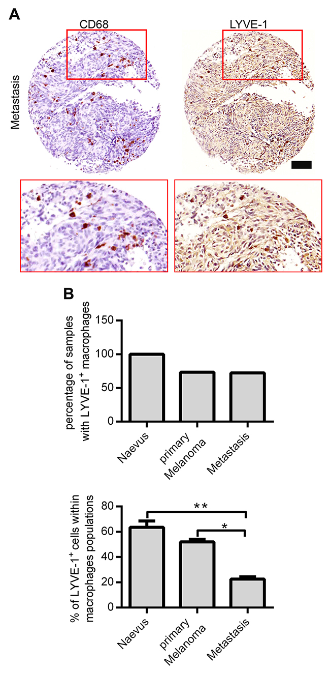 Identification and quantification of Lyve-1+ macrophages in benign and malignant melanocytic lesions.