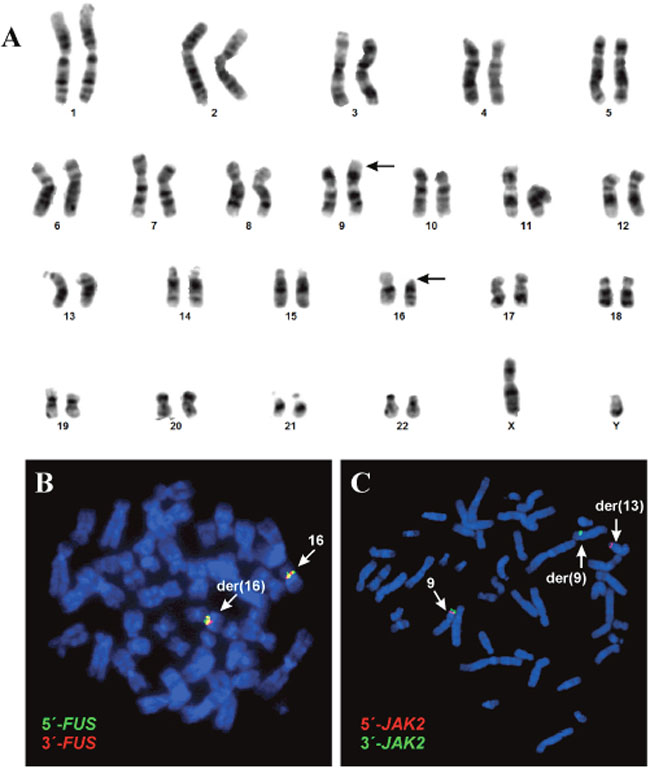 G-banding and FISH analyses of the cutaneous CD4 positive T-cell lymphoma.