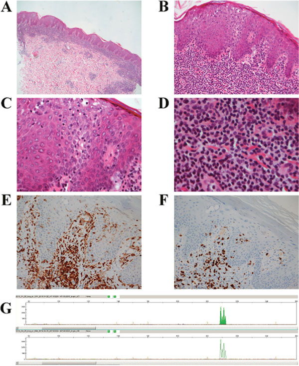 The histomorphological features of the skin lymphoma.