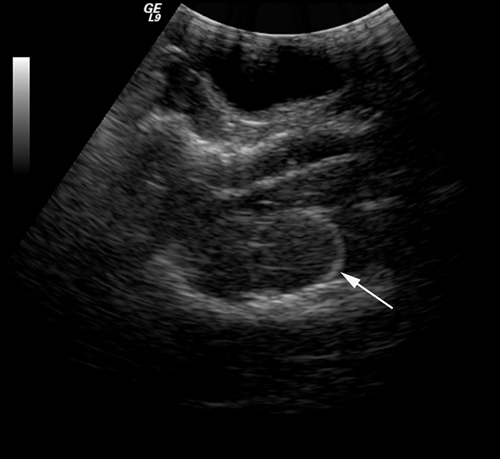 An epidural hematoma model was established, and the position of sacculus was confirmed