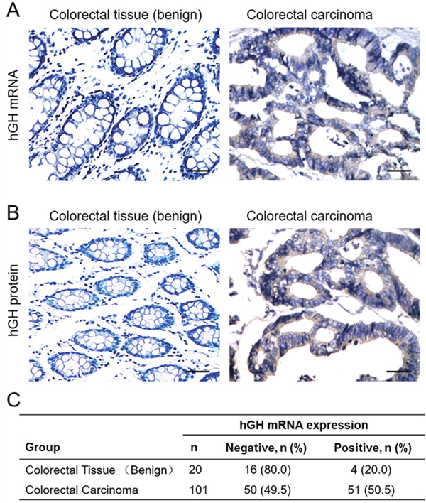 Expression of hGH in benign colorectal tissue and colorectal carcinoma (CRC).