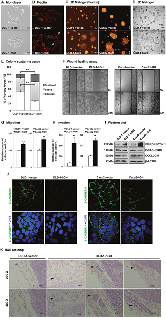 Forced expression of hGH stimulated epithelial to mesenchymal transition (EMT) in CRC cells and promoted local invasion in vivo.