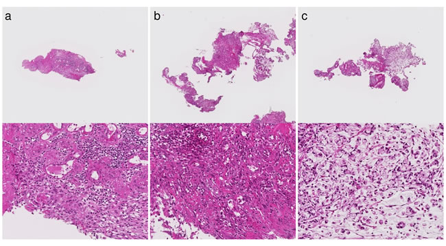 Three tissues classified as Negative(N) in case a diagnosis by human pathologists is Group 5 on East hospital dataset.