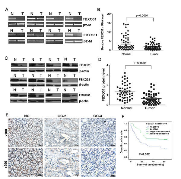 Figure1: FBXO31 expression is decreased in human GC tissues and associated with clinical grade and patients&#x2019; survival.