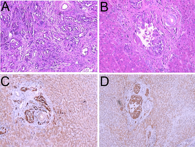 Histologic features of the epithelioid angiosarcoma.