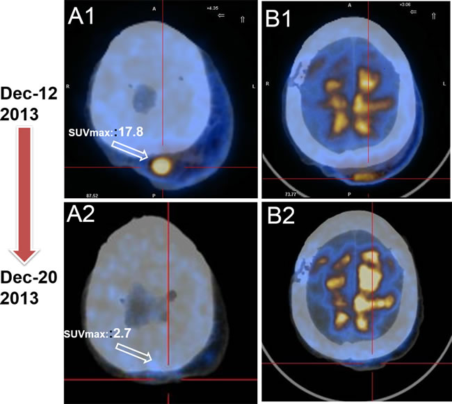 PET/CT serves as a favorable tool to evaluate the early therapy effect for EA patient.