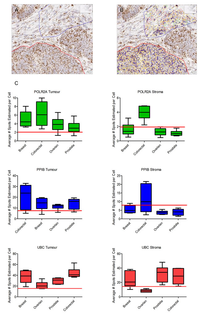 Quantitative expression by Spotstudio image analysis of three control probes in 6 cancer samples from 4 different tumour types.