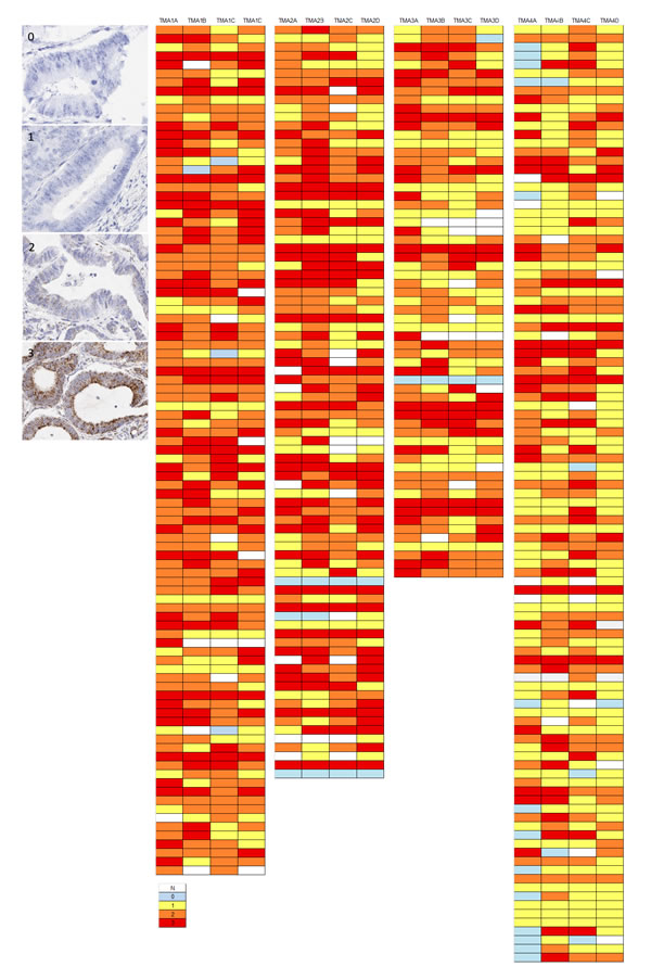 Examples of variation in PPIB expression (0-3) in individual TMA cores in a CRC series.