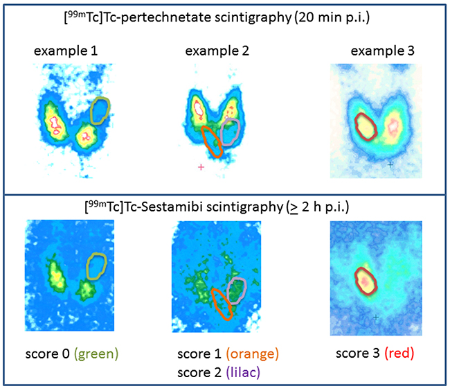 Examples of the scoring system of [99mTc]Tc-Sestamibi (MIBI)- images.
