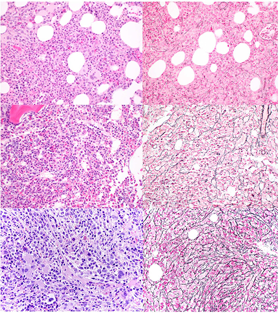 Representative BM biopsies of patients with CMML and various grades of BM fibrosis.