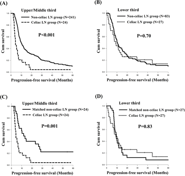 Comparison of progression-free survival curves of esophageal squamous cell carcinoma patients with different tumor locations.