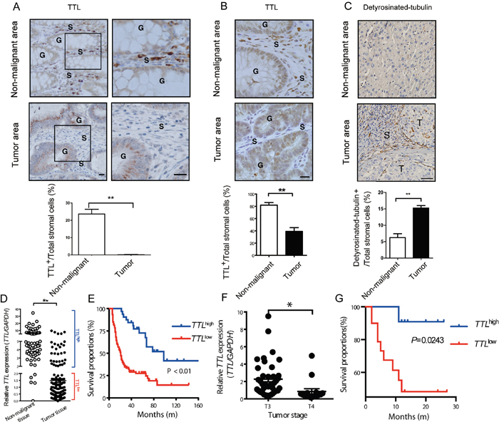 Suppressed TTL expression in stromal cells of human colon and liver cancer tissues.