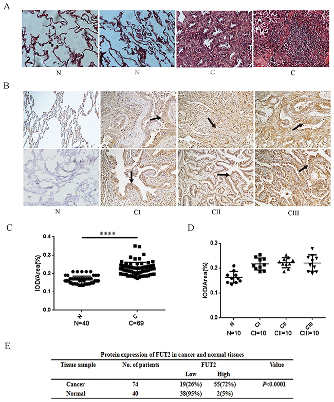 The expression levels of FUT2 protein in lung adenocarcinoma.