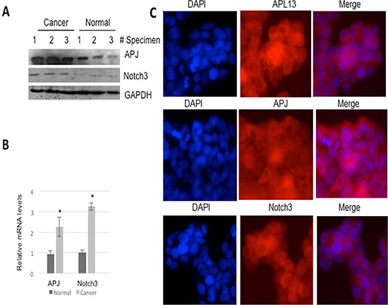 APL13, APJ, and Notch3 are overexpressed in human colon adenocarcinoma.