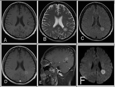 A 39-year-old male with a 10-year history of CML in relapse presents with headaches.