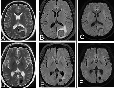 A 25-year-old female with a history of AML underwent chemotherapy and MRI follow-up.