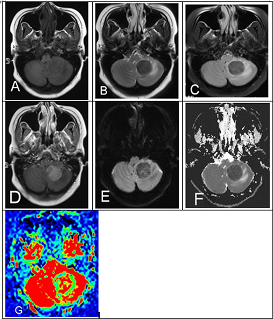 A 29-year-old female with a history of AML in remission presents with headaches, nausea and vomiting. (A)