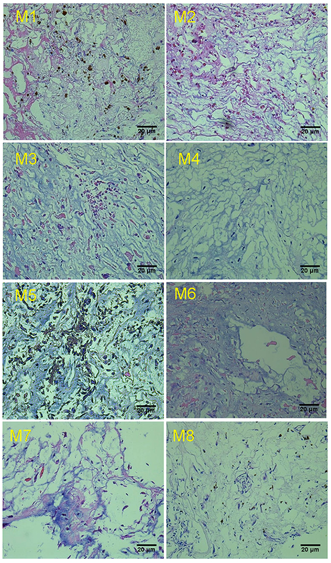 Representative Hematoxylin and Eosin staining of cardiac myxoma tissue.