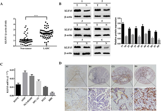 Upregulation of KLF15 in clinical specimens and LADC derived cell lines.